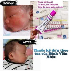 Kem Mỡ Hỗ Trợ Giảm Côn Trùng Cắn Locoid 0,1% Nhật Bản 5g - Ảnh 3