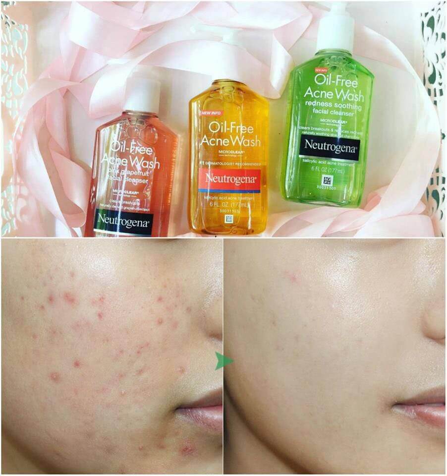 Sữa Rữa Mặt Kiềm Dầu Neutrogena Oil Free Acne Wash 150ml - Ảnh 5