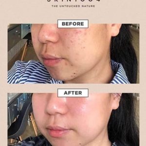 REVIEW nước hoa hồng rau má Skin1004 Madagascar