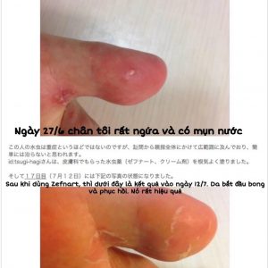 REVIEW thuốc trị nấm da ZEFNART