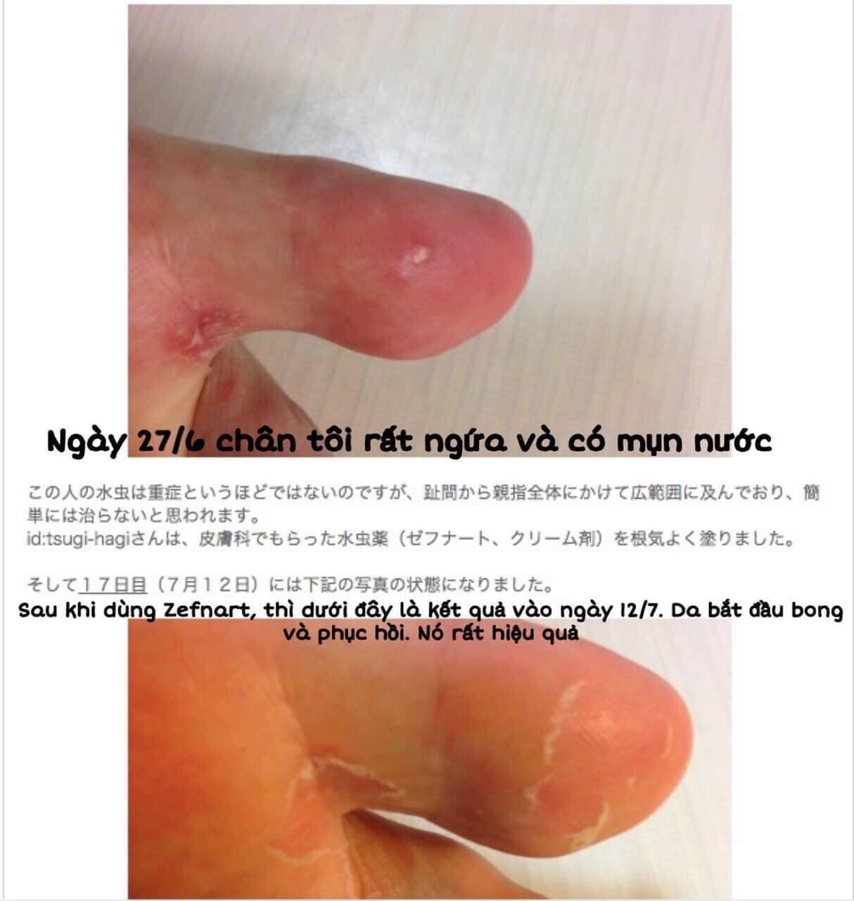 REVIEW thuốc trị nấm da ZEFNART