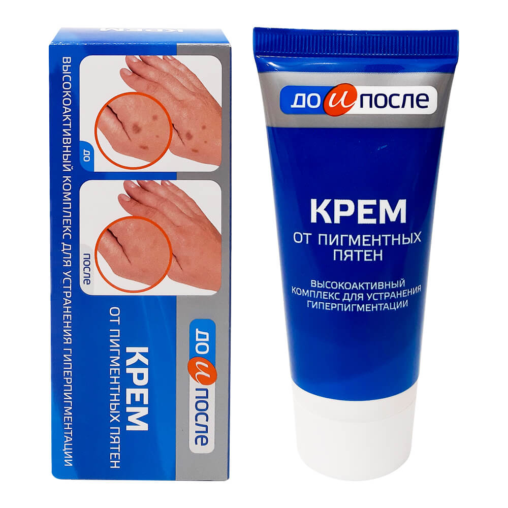 REVIEW kem trị đồi mồi Kpem của Nga có tốt không