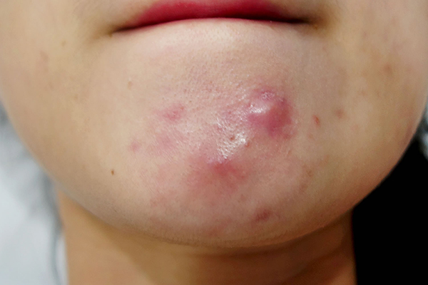 mụn viêm không nhân