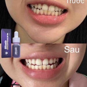 cách tẩy trắng răng ố vàng